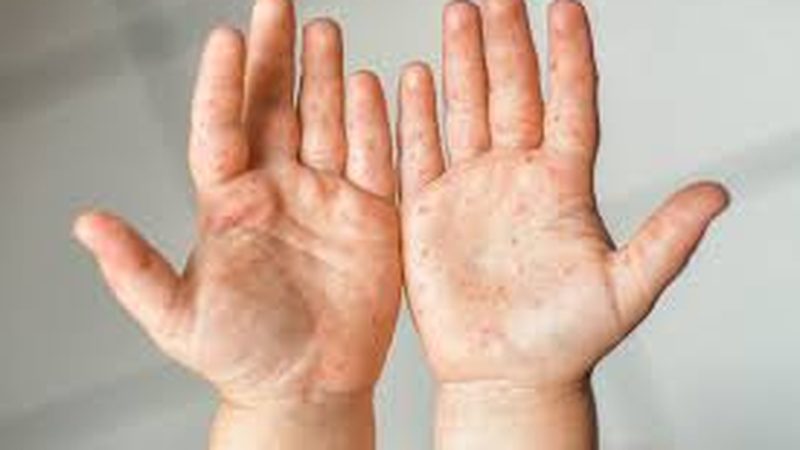 پنجاب میں خسرے کے کیسز میں اضافہ