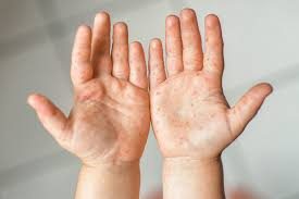 پنجاب میں خسرے کے کیسز میں اضافہ